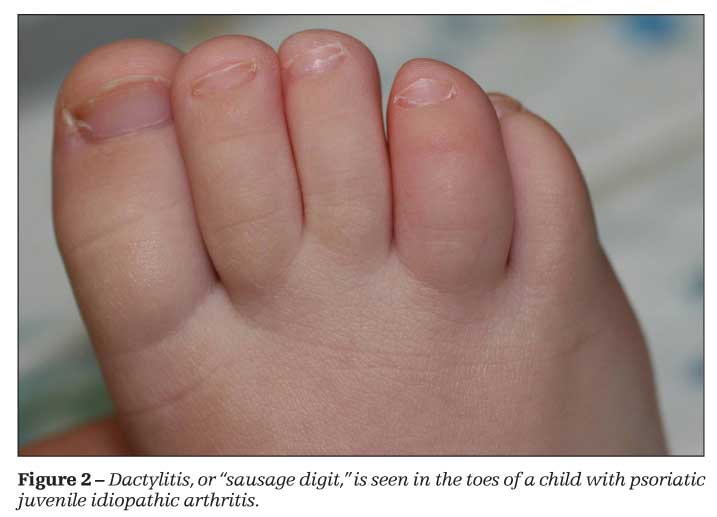 Early identification of juvenile idiopathic arthritis